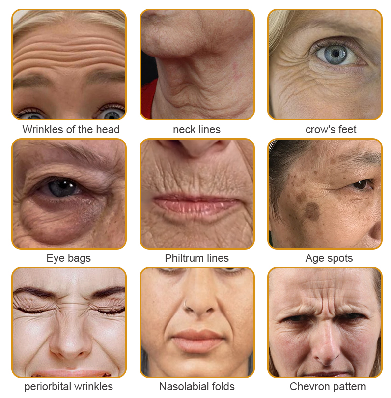 (✅Made and Shipped from UK👨⚕️)✨Flysmus® Botox Bee Venom Wrinkle Removal Cream-Last Day Promotion 70% OFF