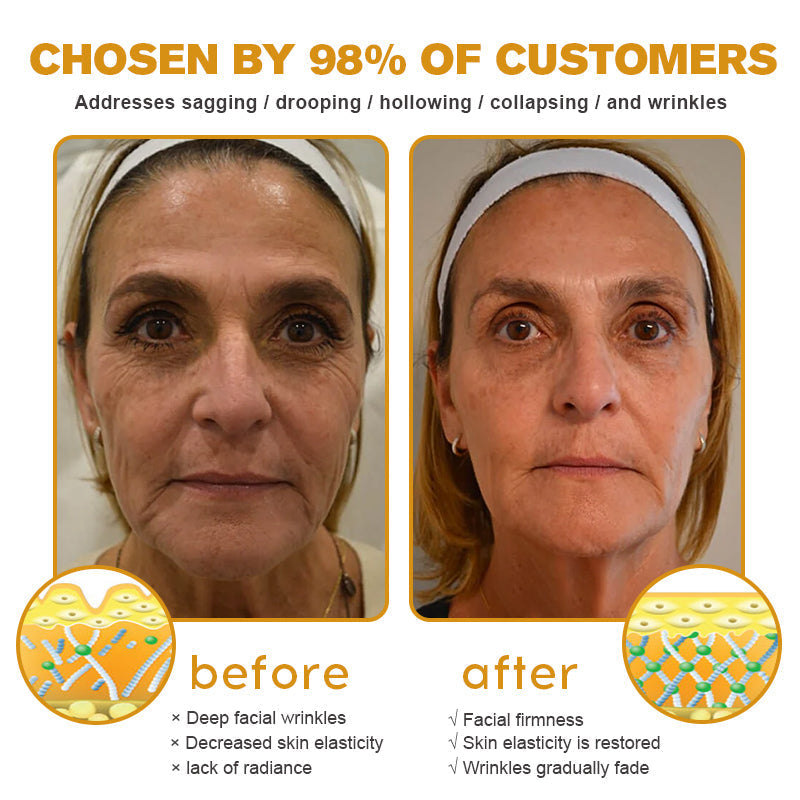 (✅Made and Shipped from UK👨⚕️)✨Flysmus® Botox Bee Venom Wrinkle Removal Cream-Last Day Promotion 70% OFF